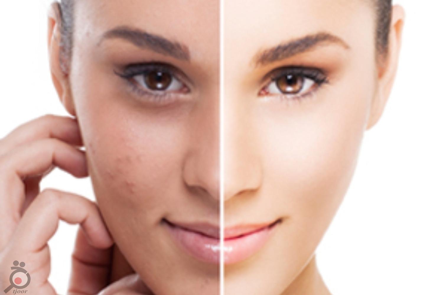 تخفیف ویژه خدمات پوشت و لیزر در کلینیک رها تخفیف ویژه خدمات پوشت و لیزر در کلینیک رها