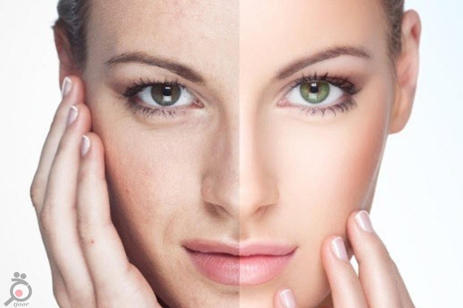 تخفیف ویژه خدمات پوشت و لیزر در کلینیک رها تخفیف ویژه خدمات پوشت و لیزر در کلینیک رها