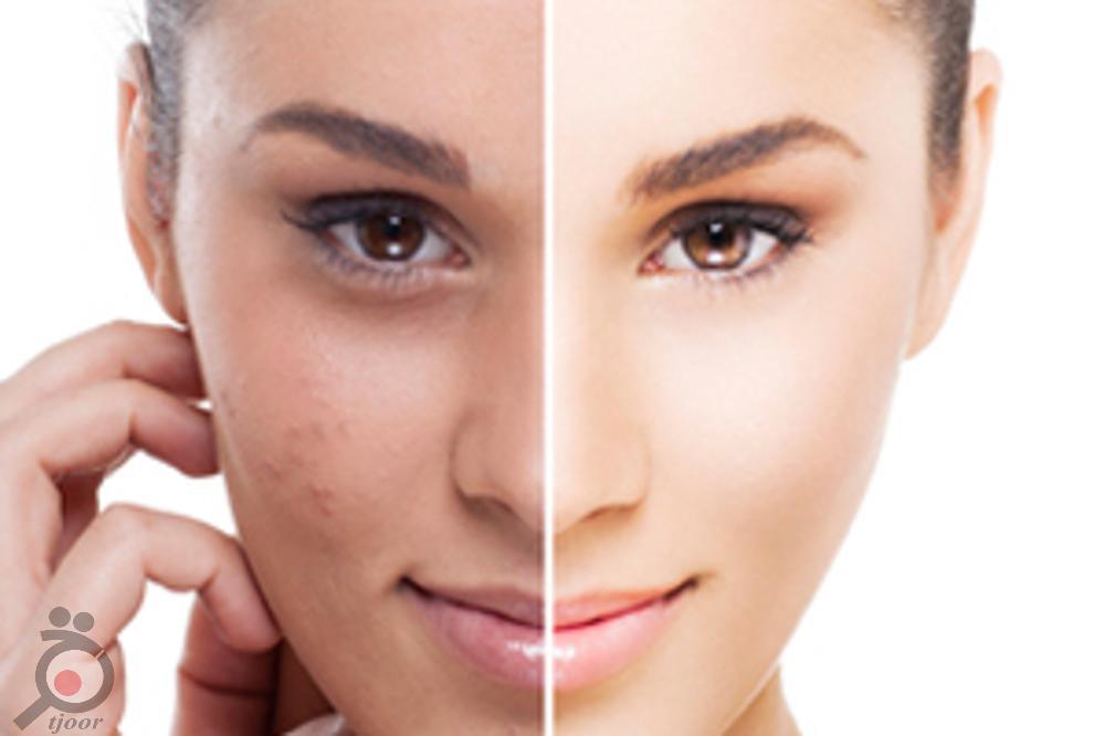 تخفیف ویژه لیزر موهای زائد در کلینیک پوست و لیزر ونوس تخفیف ویژه لیزر موهای زائد در کلینیک پوست و لیزر ونوس