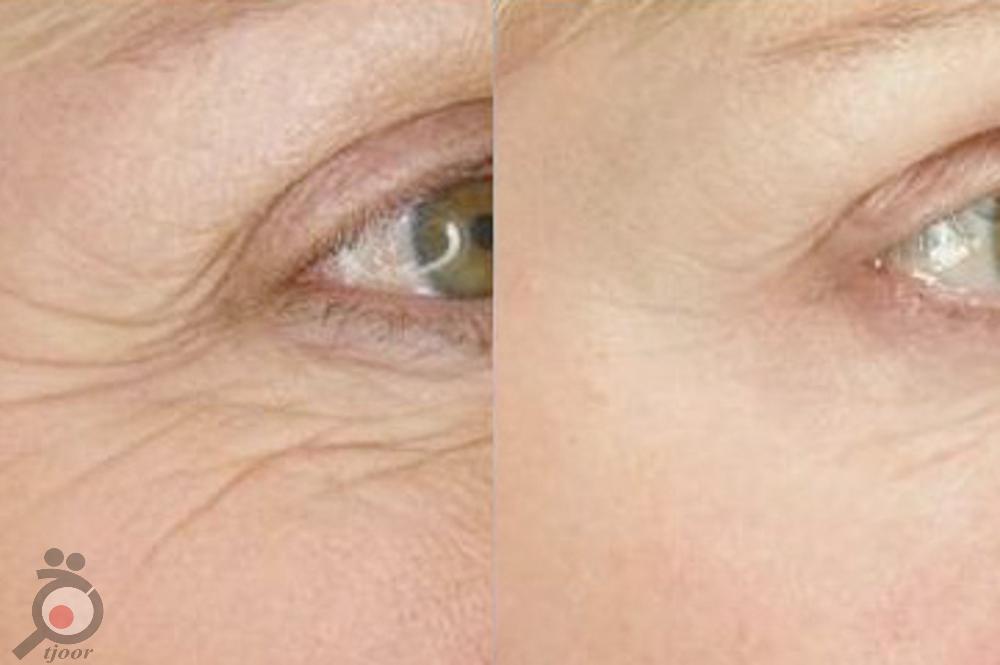 تخفیف ویژه لیزر موهای زائد در کلینیک پوست و لیزر ونوس تخفیف ویژه لیزر موهای زائد در کلینیک پوست و لیزر ونوس