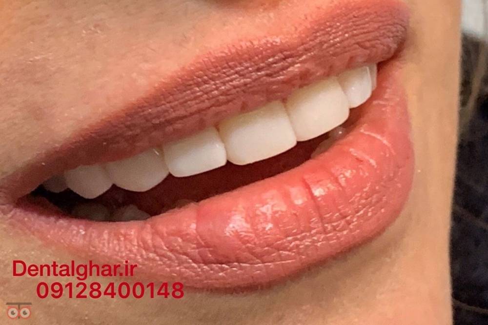 تخفیف ویژه کامپوزیت دندان تخفیف ویژه کامپوزیت دندان