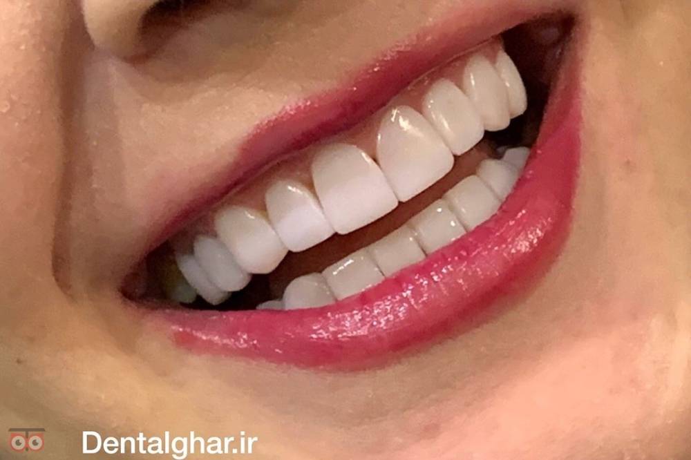 تخفیف ویژه کامپوزیت دندان تخفیف ویژه کامپوزیت دندان