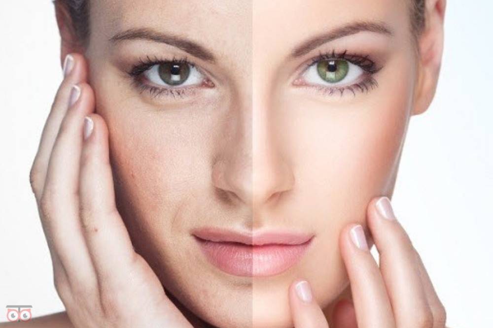 تخفیف ویژه انواع خدمات زیبایی شامل: فیلر ، بوتاکس، لیزر، میکروبیلدینگ، مزوتراپی تخفیف ویژه انواع خدمات زیبایی شامل: فیلر ، بوتاکس، لیزر، میکروبیلدینگ، مزوتراپی