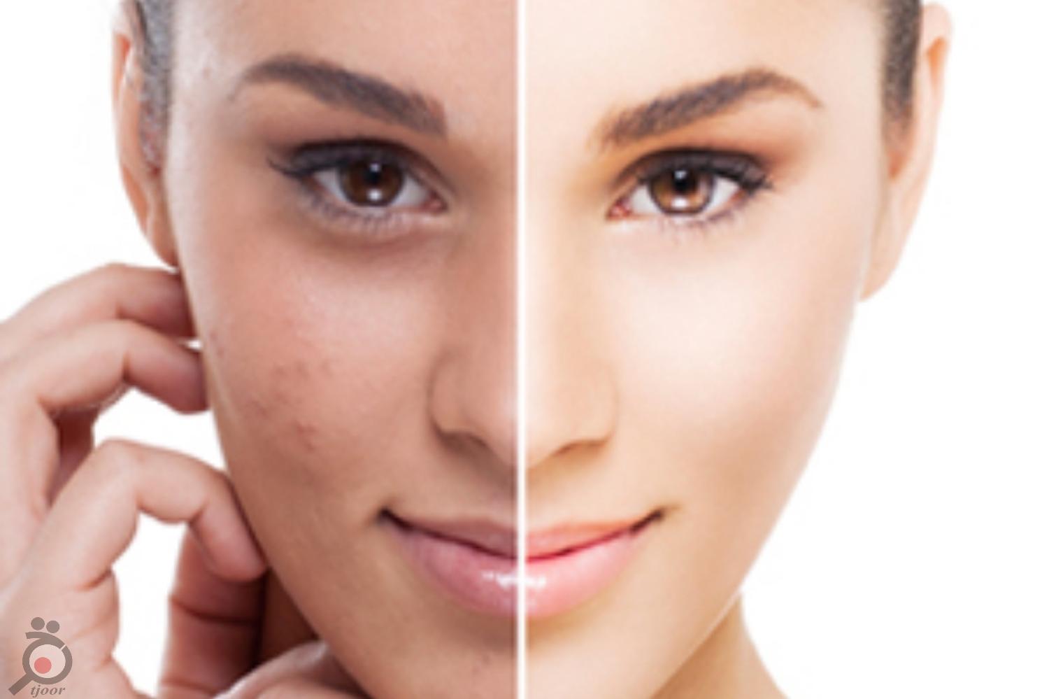 تخفیف جوانسازی، لیفت صورت و هایفو تراپی تخفیف جوانسازی، لیفت صورت و هایفو تراپی