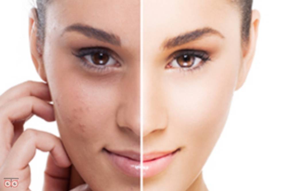 تخفیف ویژه لیزر موهای زائد تخفیف ویژه لیزر موهای زائد