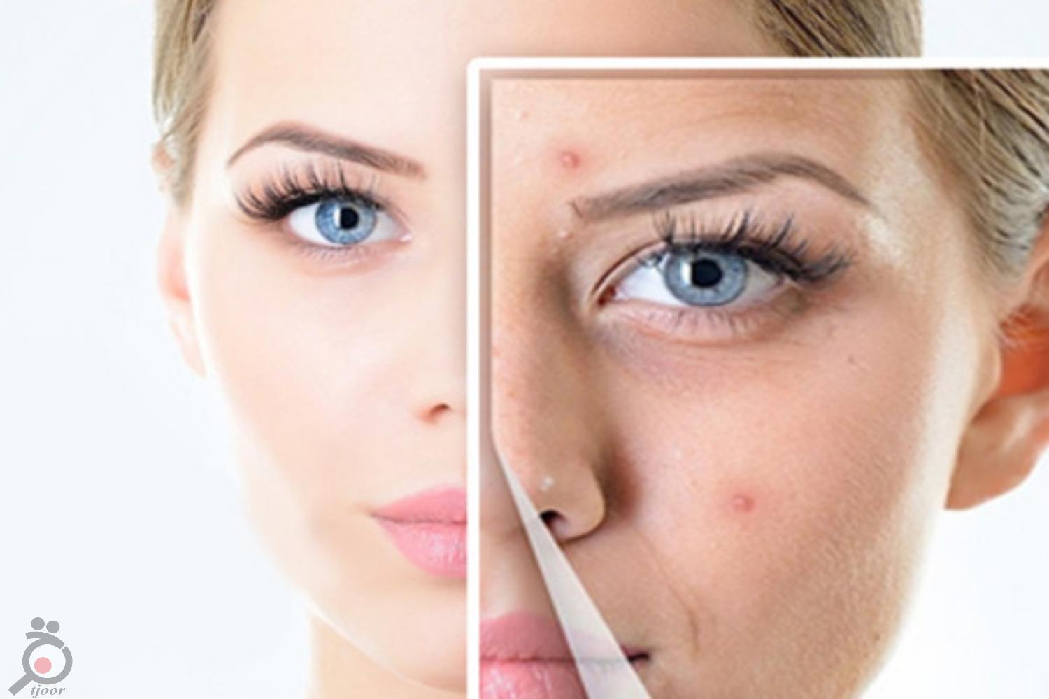 تخفیف لیزر در کلینیک لیانا تخفیف لیزر در کلینیک لیانا