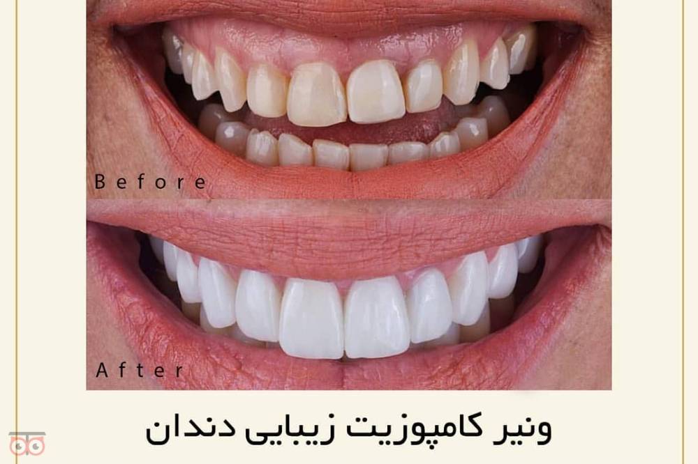 تخفیف ویژه خدمات دندانپزشکی تخفیف ویژه خدمات دندانپزشکی