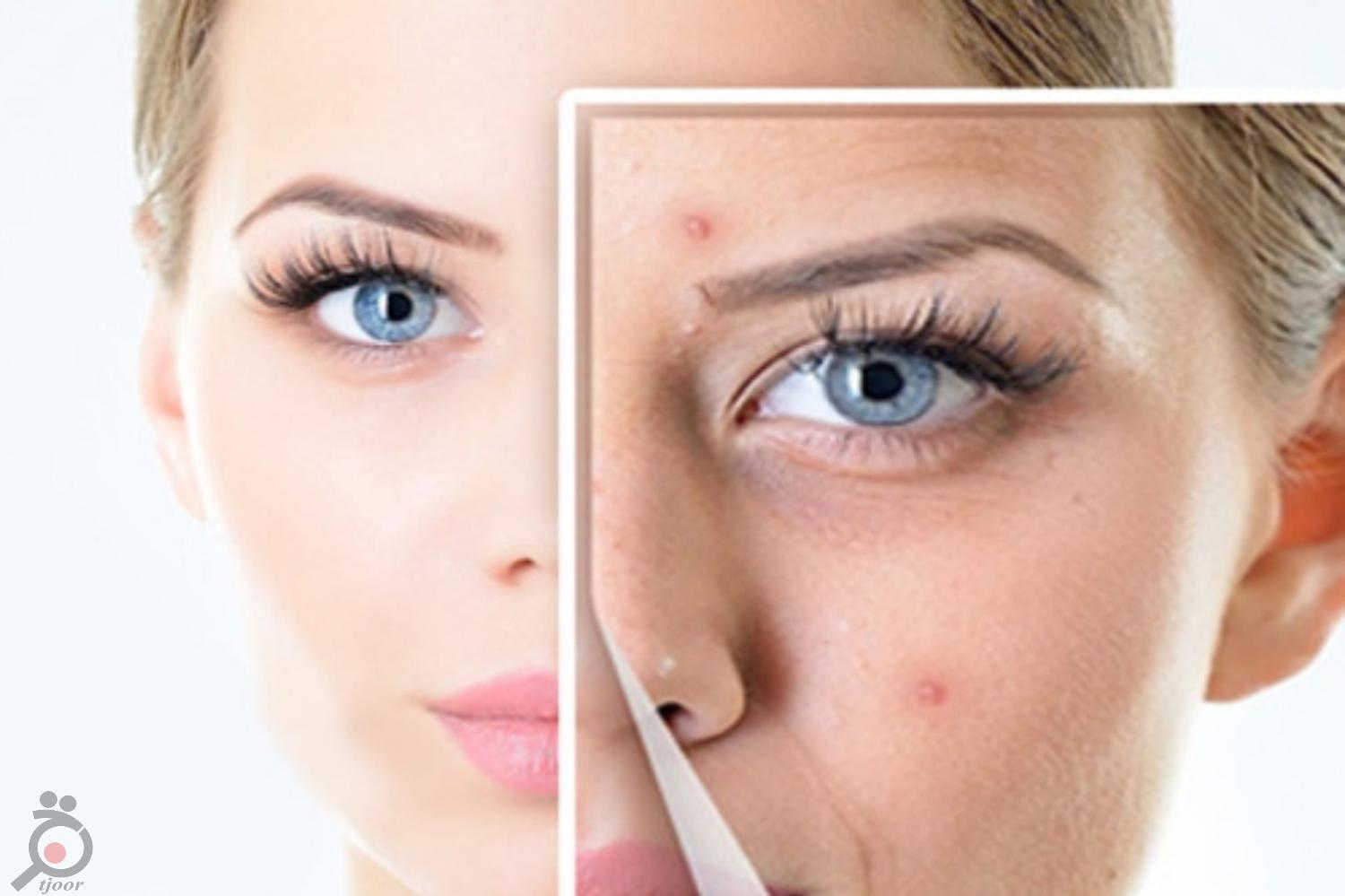 تخفیف درمان لک و جای جوش تخفیف درمان لک و جای جوش