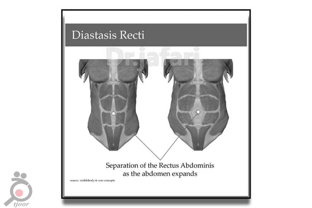 تخفیف ویژه لیپوماتیک تخفیف ویژه لیپوماتیک