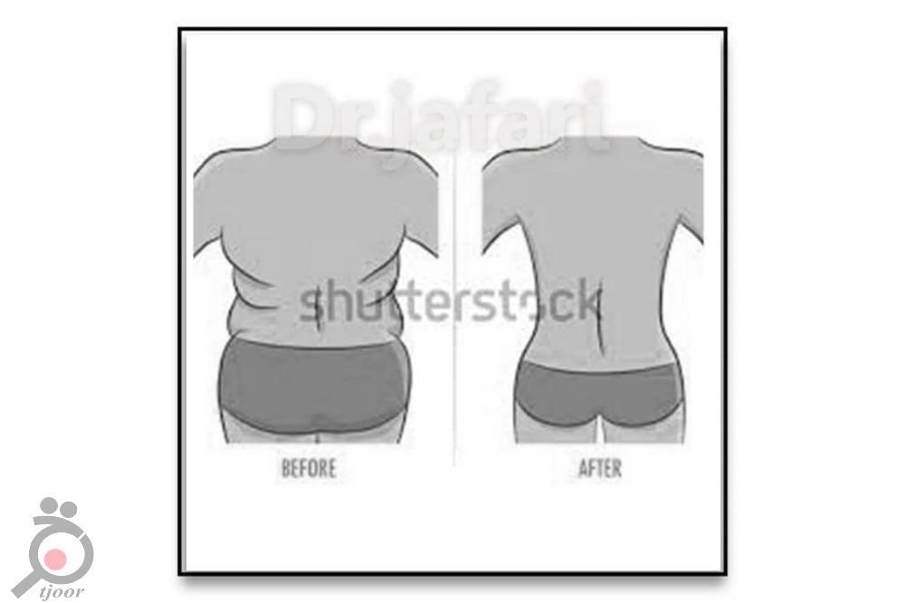 تخفیف ویژه لیپوماتیک تخفیف ویژه لیپوماتیک