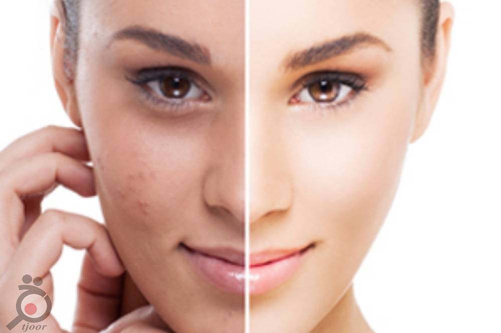 تخفیف ویژه کلینیک دکتر میرزایی تخفیف ویژه کلینیک دکتر میرزایی