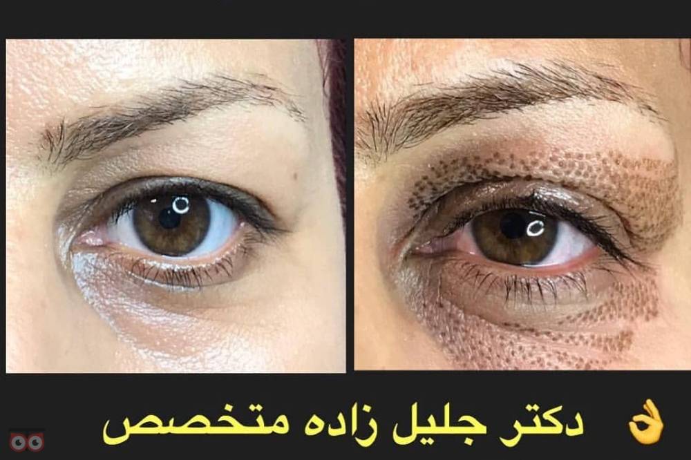 تخفیف ویژه خدمات جوانسازی و رفع چین و چروک تخفیف ویژه خدمات جوانسازی و رفع چین و چروک
