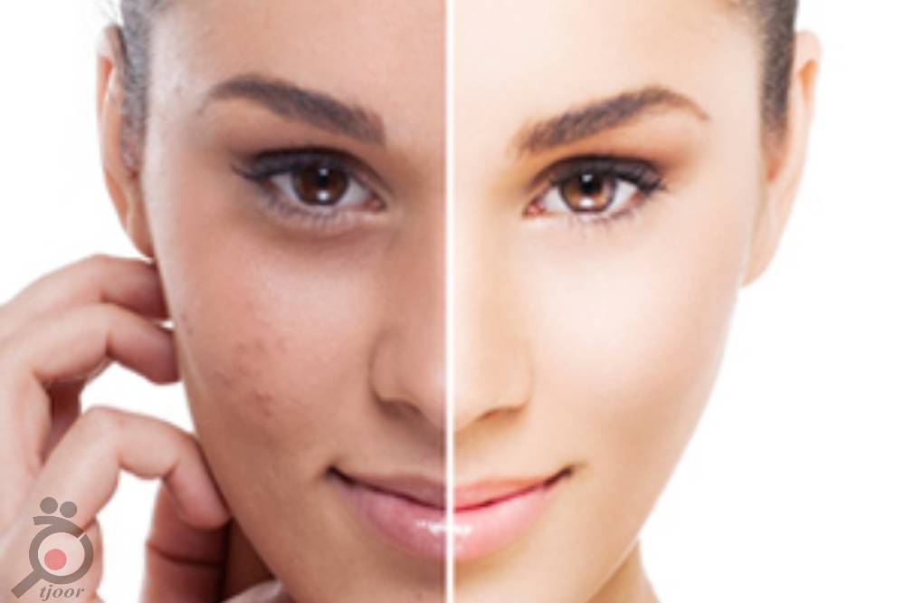 تخفیف ویژه فشیال و پاکسازی صورت تخفیف ویژه فشیال و پاکسازی صورت