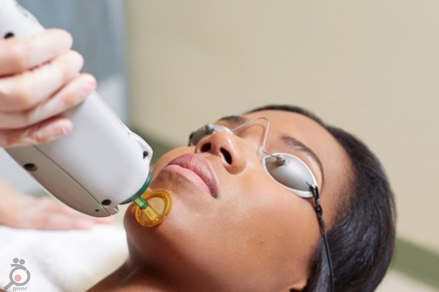 تخفیف ویژه لیزر موهای زائد تخفیف ویژه لیزر موهای زائد