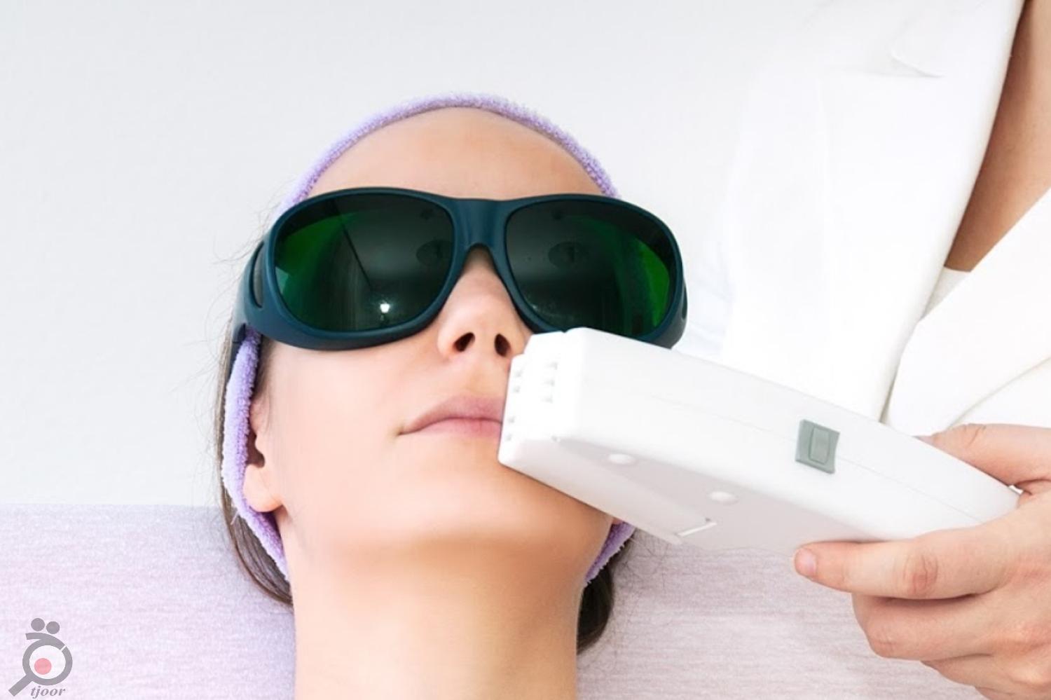 تخفیف ویژه لیزر موهای زائد تخفیف ویژه لیزر موهای زائد