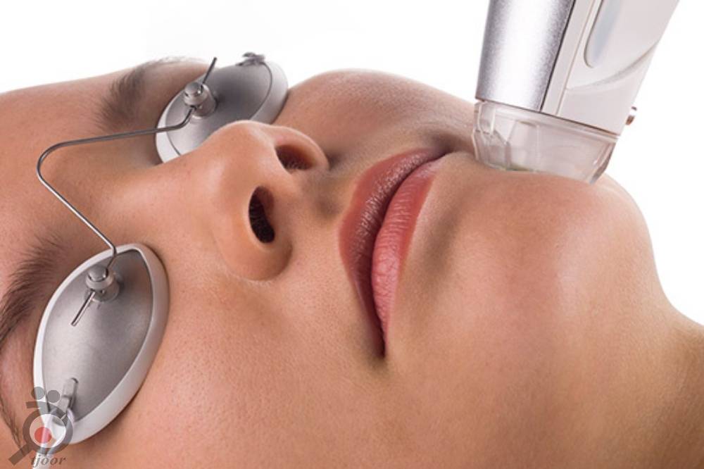 تخفیف میکرونیدلینگ تخفیف میکرونیدلینگ