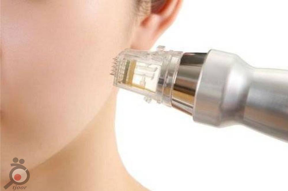 تخفیف میکرونیدلینگ تخفیف میکرونیدلینگ