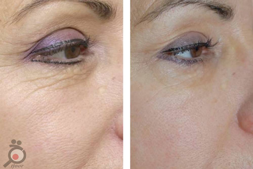 تخفیف ویژه پلاسما جت تخفیف ویژه پلاسما جت