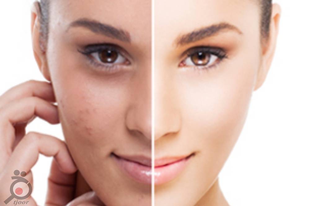 تخفیف ویژه پلاسما جت تخفیف ویژه پلاسما جت