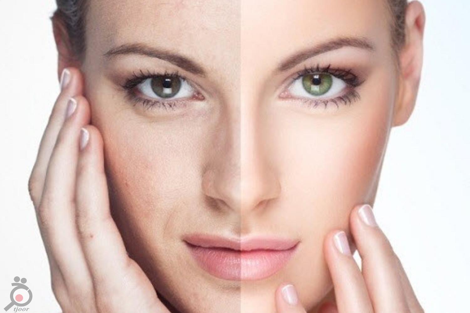 تخفیف رفع چین و چروک پلک و صورت تخفیف رفع چین و چروک پلک و صورت