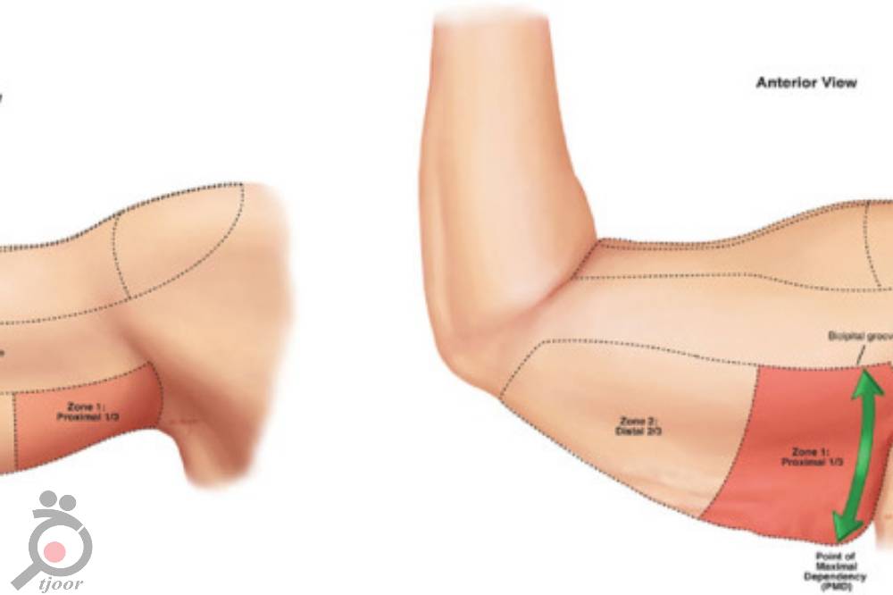 تخفیف ویژه مزوتراپی لاغری و کم کردن سایز