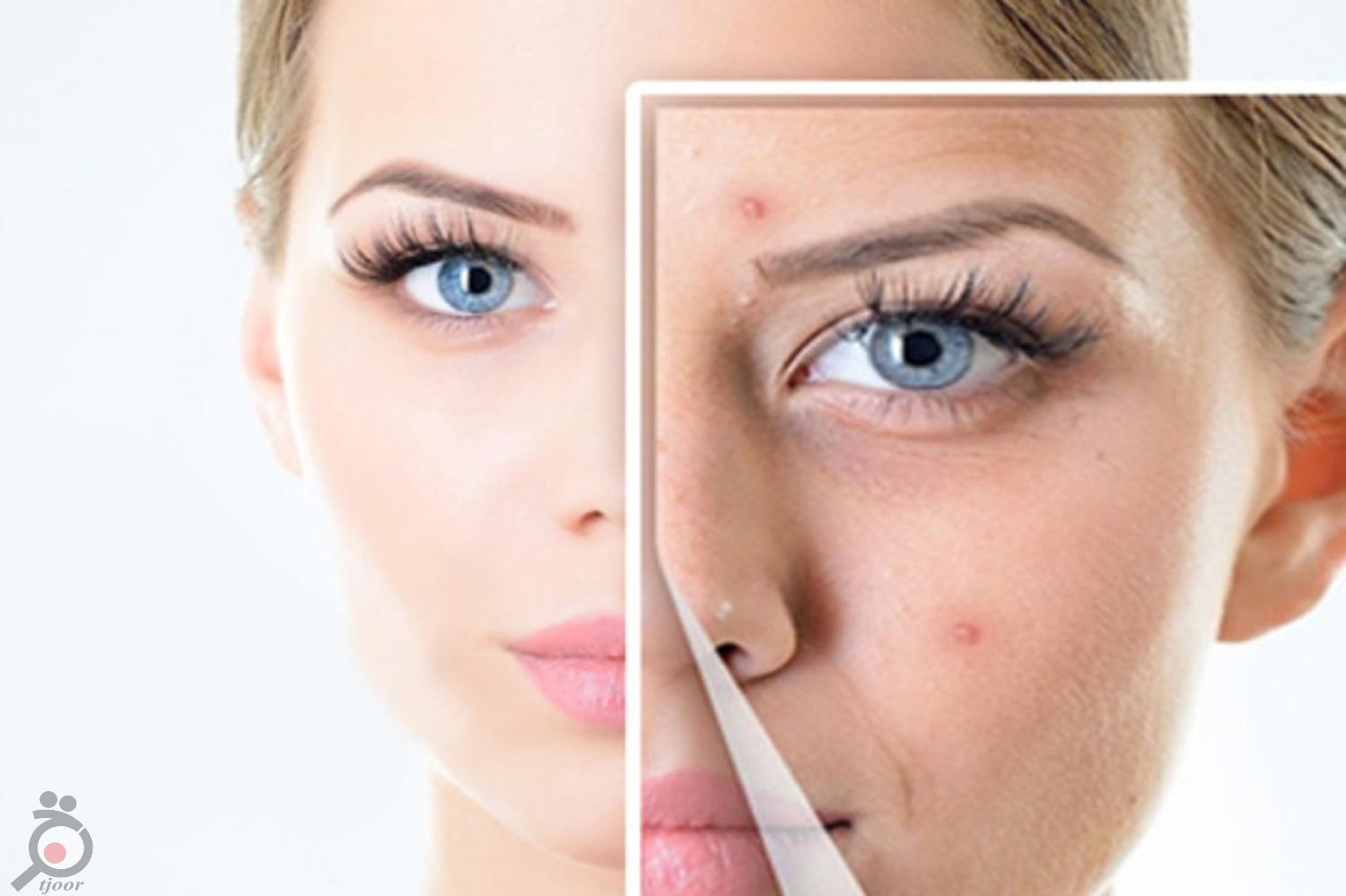 تخفیف ویژه رفع جای لک و اسکار با دستگاه تیکسل تخفیف ویژه رفع جای لک و اسکار با دستگاه تیکسل