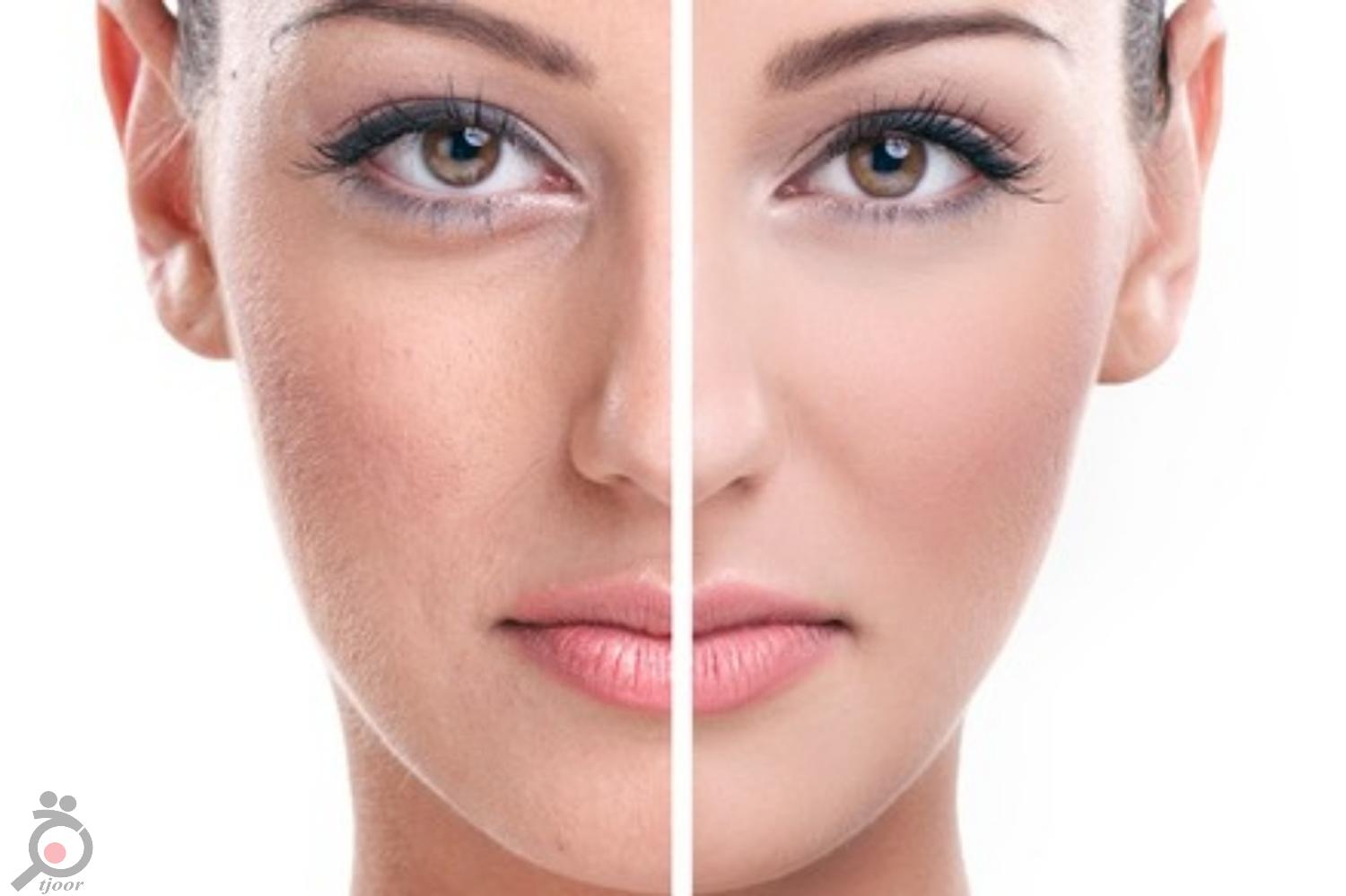 تخفیف ویژه رفع جای لک و اسکار با دستگاه تیکسل تخفیف ویژه رفع جای لک و اسکار با دستگاه تیکسل