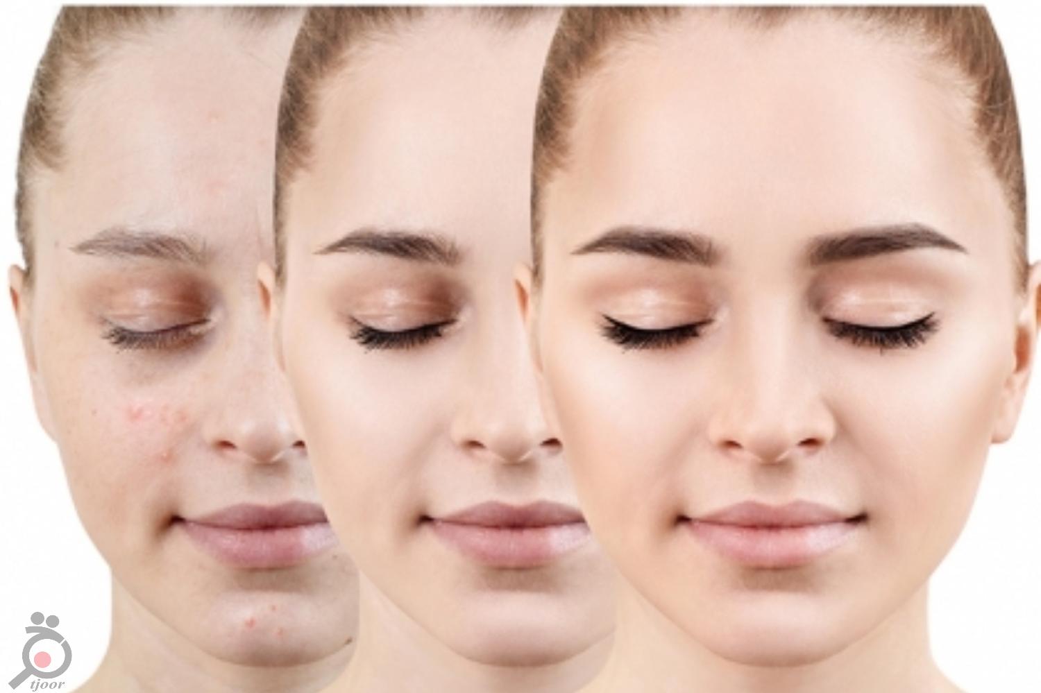 تخفیف ویژه رفع جای لک و اسکار با دستگاه تیکسل تخفیف ویژه رفع جای لک و اسکار با دستگاه تیکسل