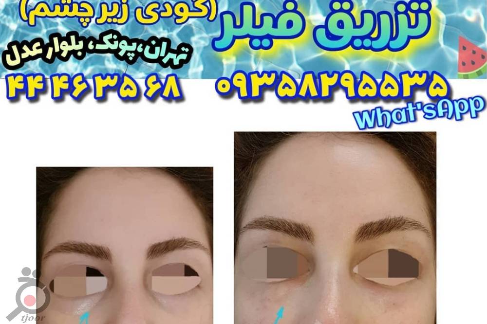 جشنواره تخفیفات تابستانی بر روی فیلر جشنواره تخفیفات تابستانی بر روی فیلر