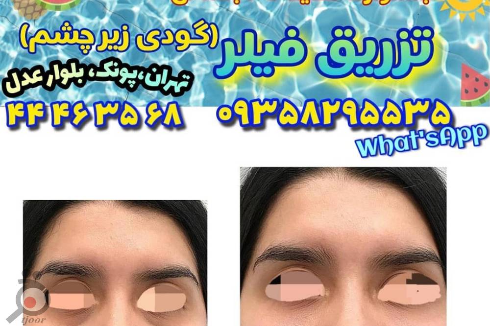 جشنواره تخفیفات تابستانی بر روی فیلر جشنواره تخفیفات تابستانی بر روی فیلر