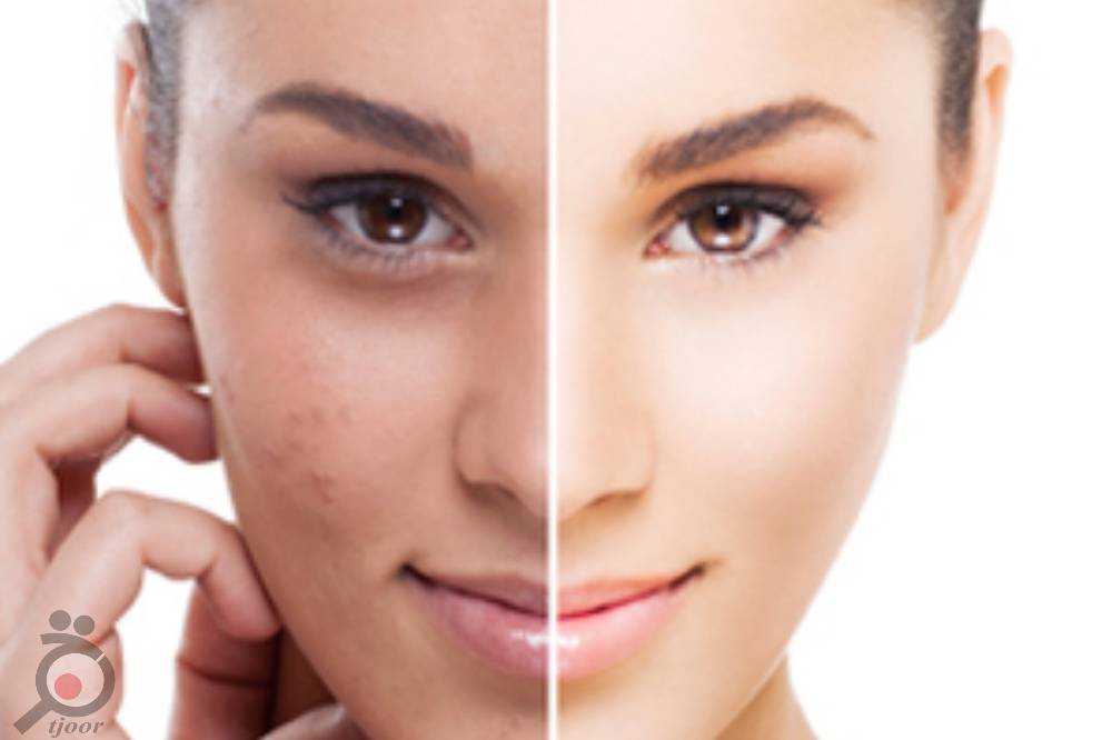 تخفیف ویژه پاکسازی بوسیله اسکوم تراپی تخفیف ویژه پاکسازی بوسیله اسکوم تراپی