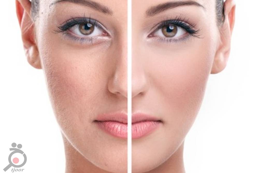 تخفیف ویژه پاکسازی بوسیله اسکوم تراپی تخفیف ویژه پاکسازی بوسیله اسکوم تراپی