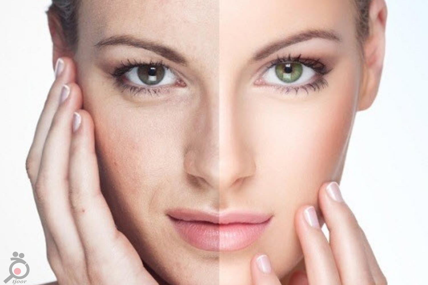 تخفیف ویژه رفع چروک دور چشم و جوانسازی دور چشم تخفیف ویژه رفع چروک دور چشم و جوانسازی دور چشم