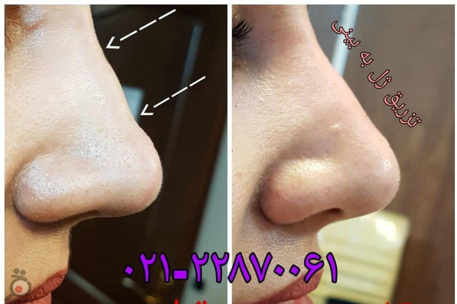 تخفیف تزریق ژل اصلاح فرم بینی تخفیف تزریق ژل اصلاح فرم بینی