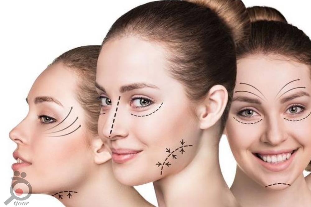 تخفیف ویژه عمل لیفت صورت تخفیف ویژه عمل لیفت صورت